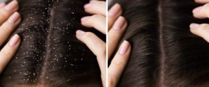 Dry Scalp vs. Dandruff. Learn the difference and fix it
